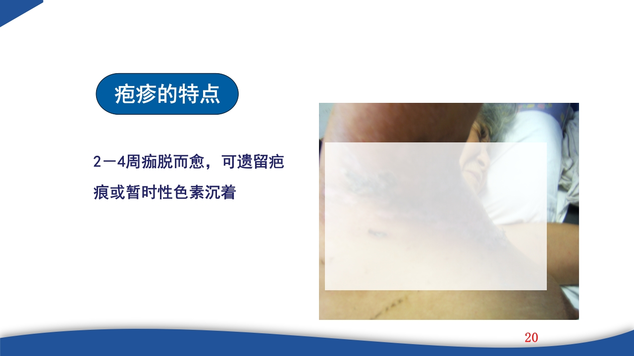 带状疱疹教学PPT课件20