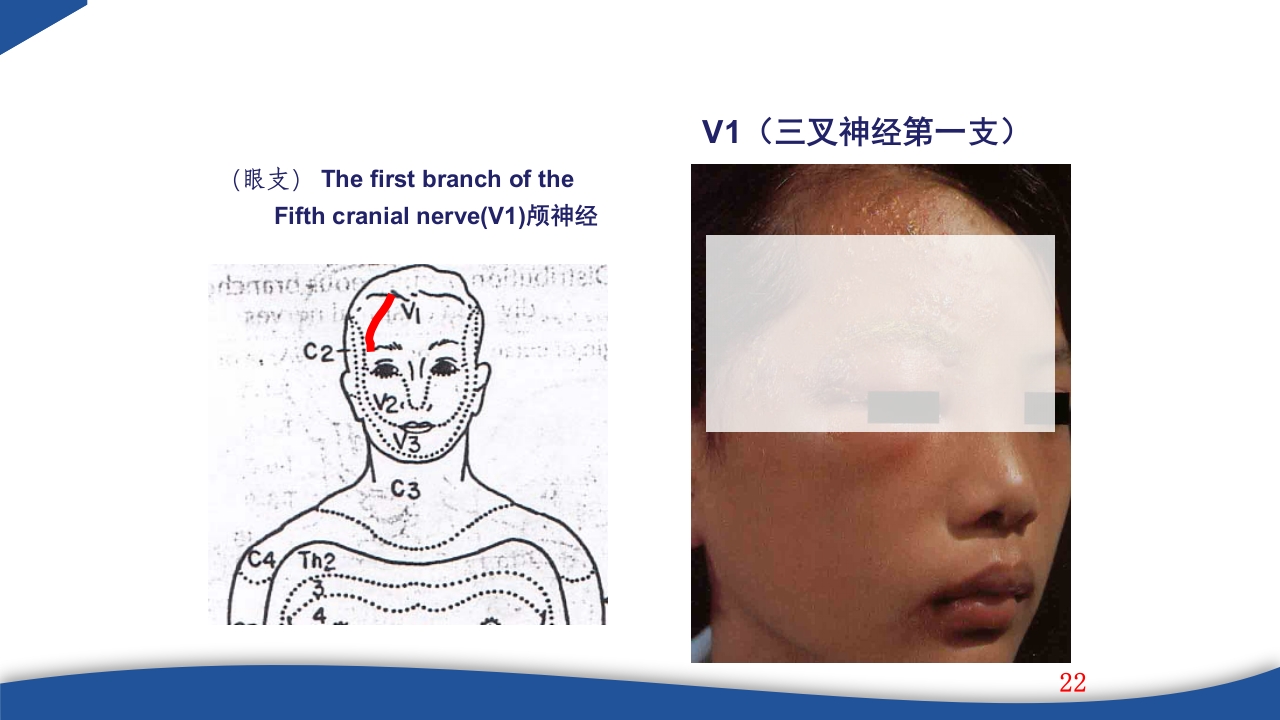 带状疱疹教学PPT课件22