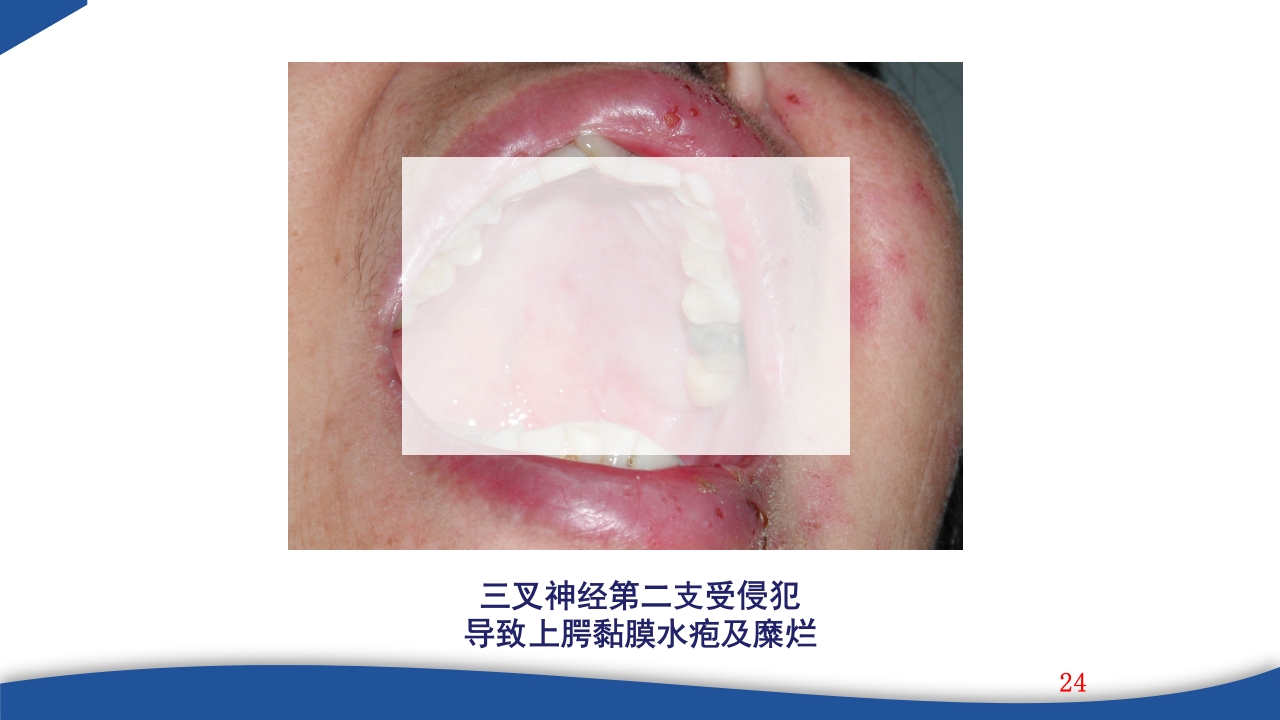 带状疱疹教学PPT课件24
