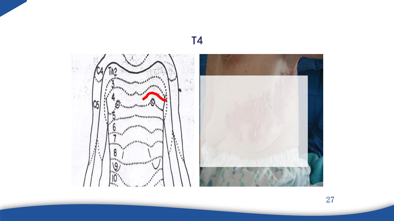 带状疱疹教学PPT课件27