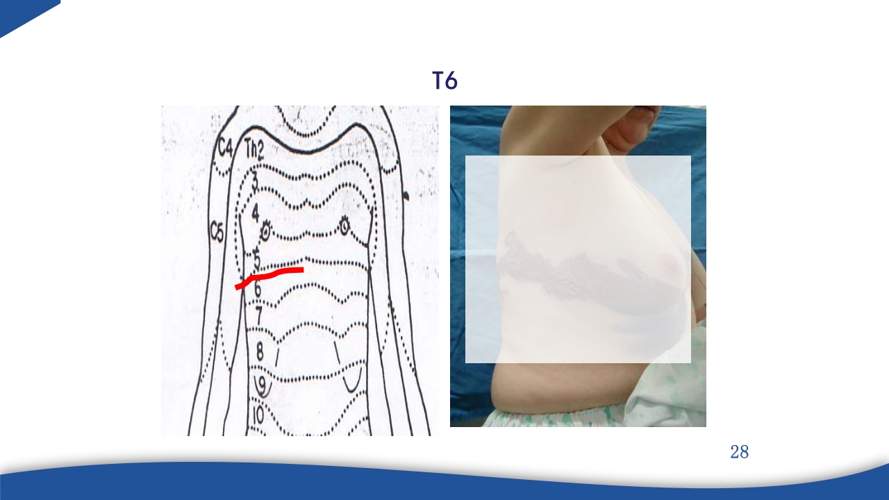 带状疱疹教学PPT课件28