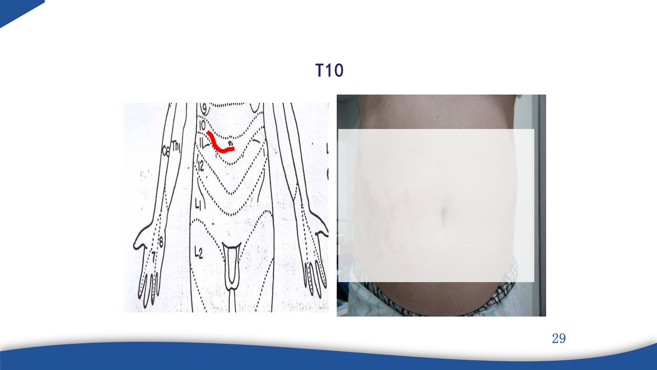 带状疱疹教学PPT课件29