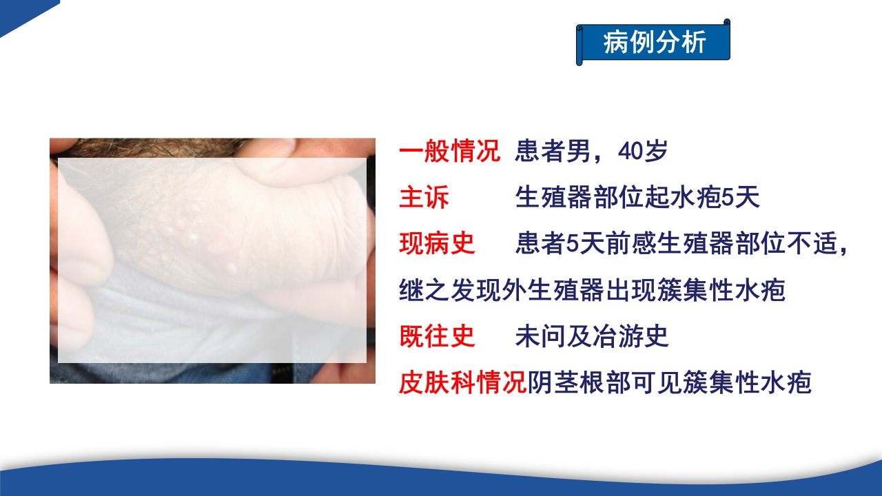 带状疱疹教学PPT课件2
