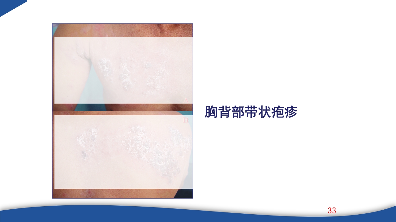 带状疱疹教学PPT课件33
