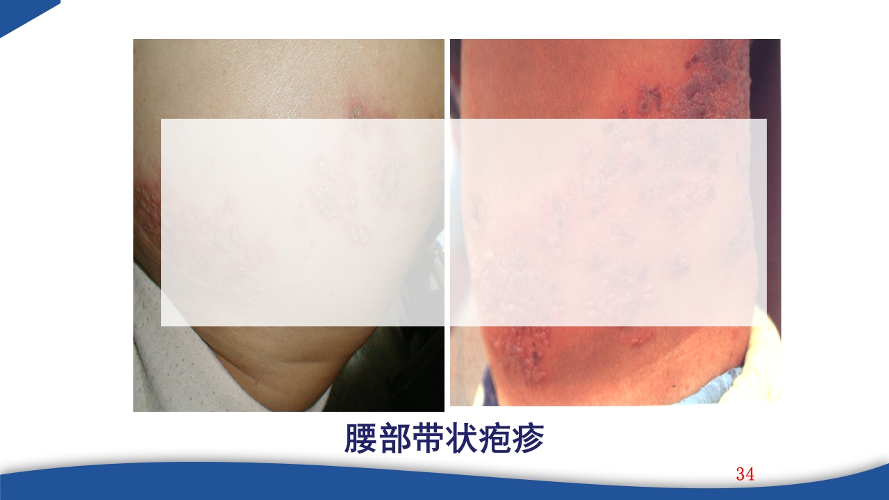 带状疱疹教学PPT课件34