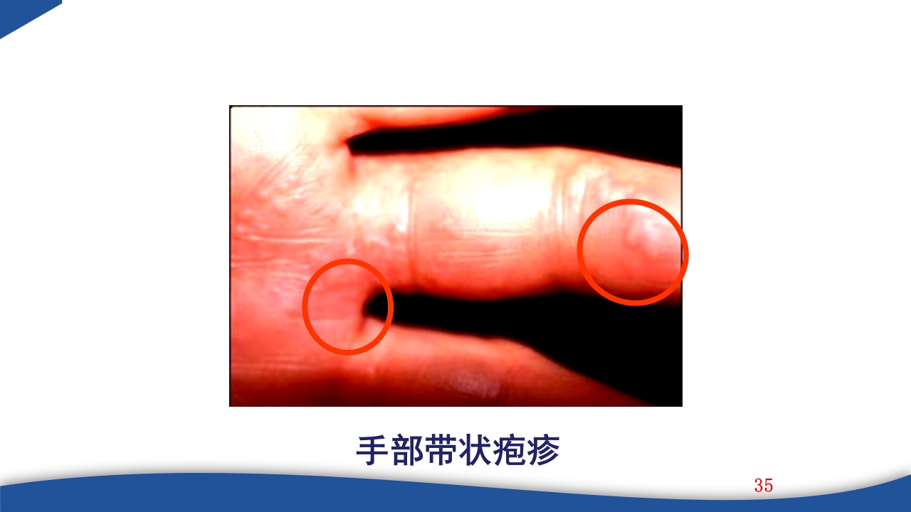 带状疱疹教学PPT课件35