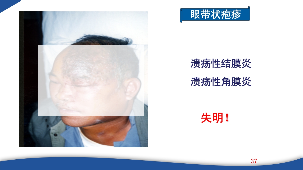 带状疱疹教学PPT课件37