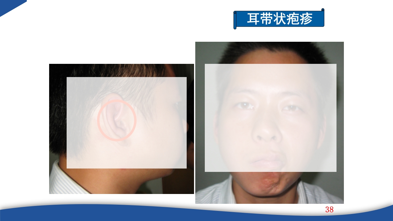 带状疱疹教学PPT课件38