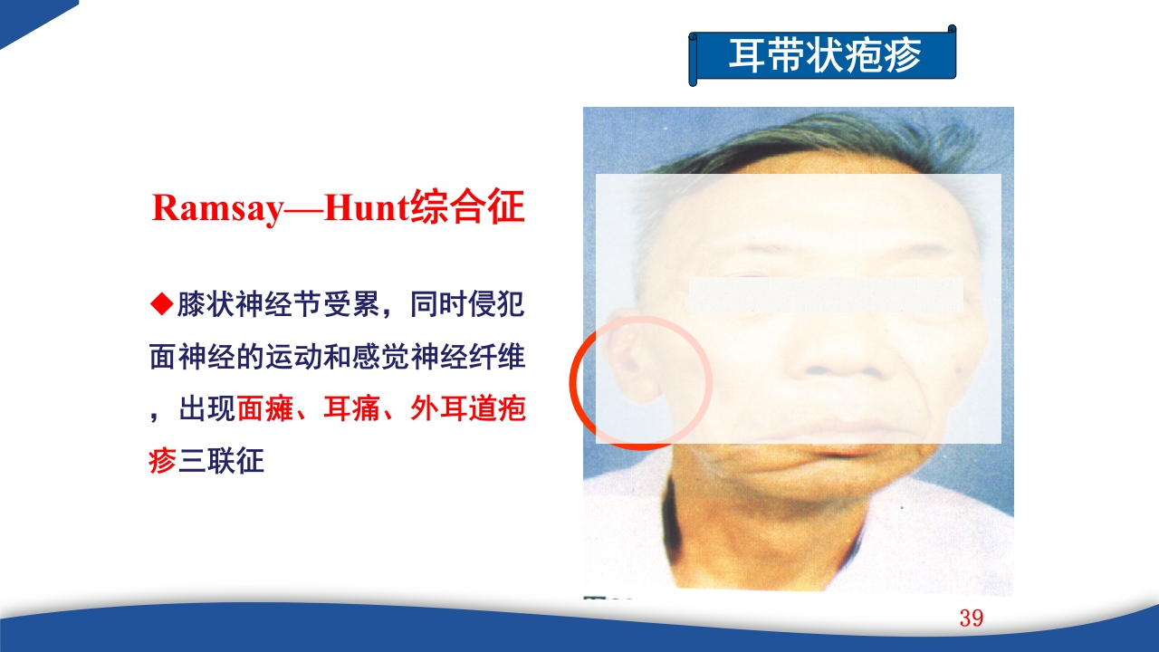 带状疱疹教学PPT课件39