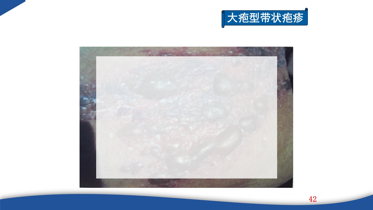 带状疱疹教学PPT课件42