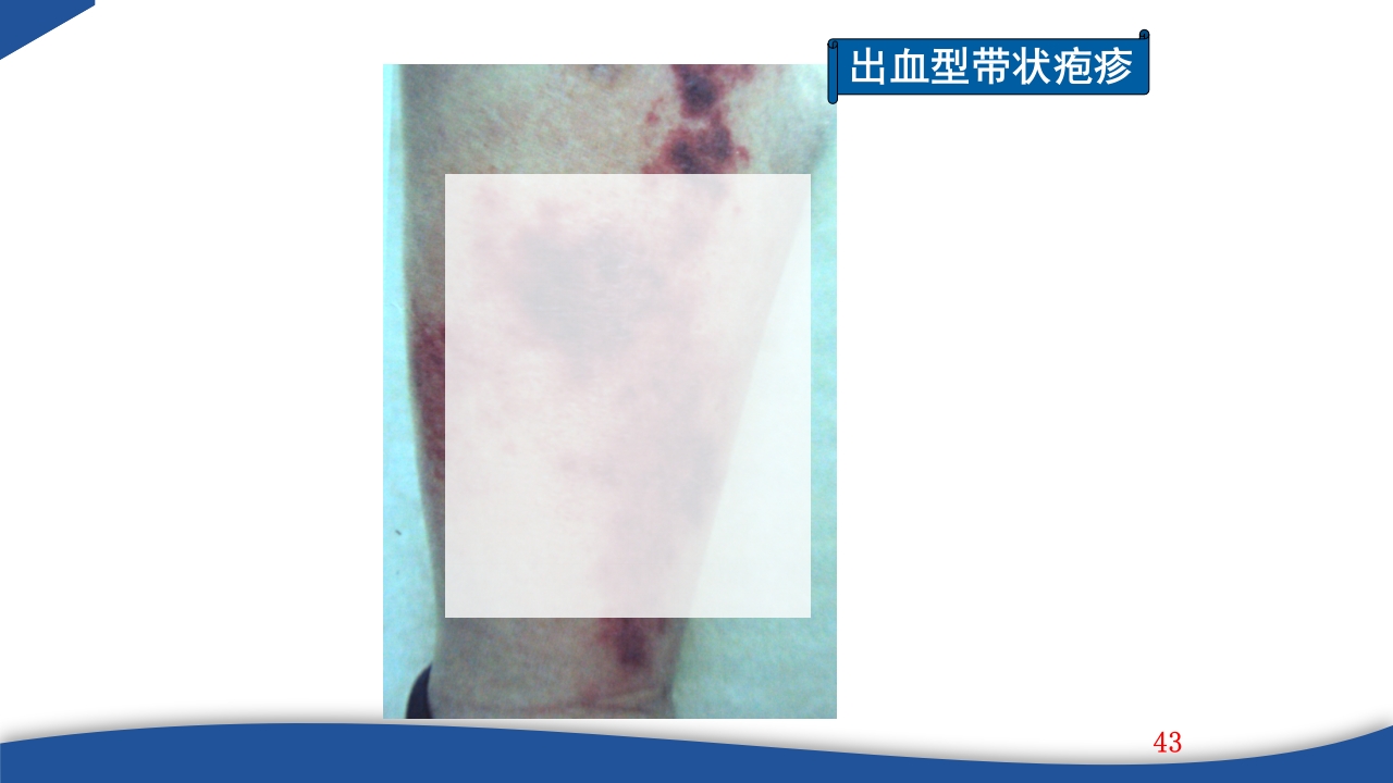 带状疱疹教学PPT课件43