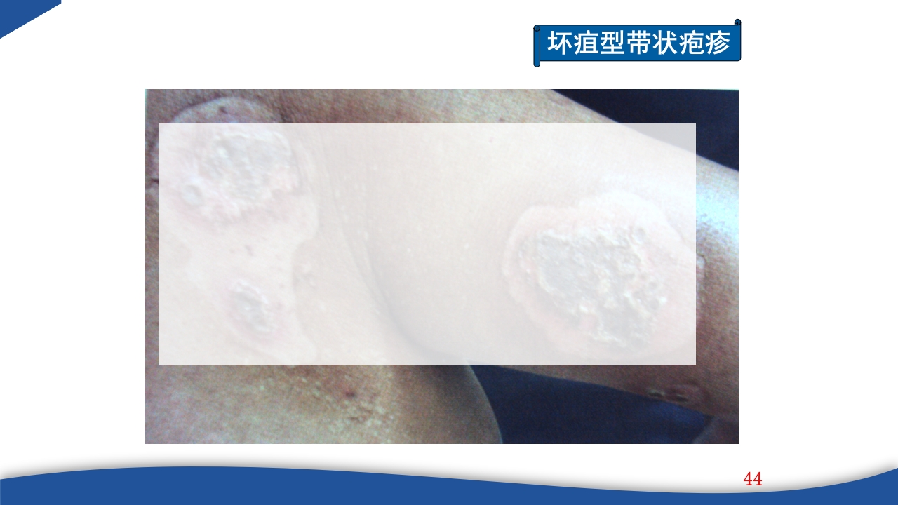 带状疱疹教学PPT课件44