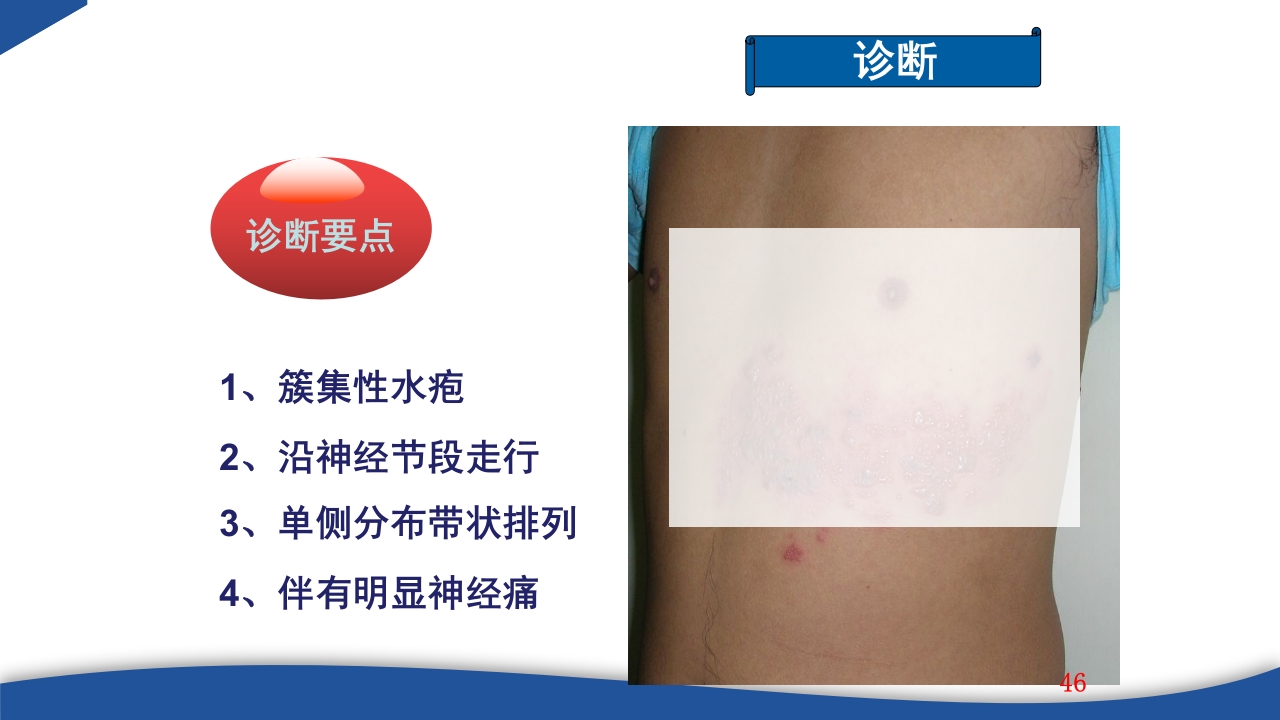 带状疱疹教学PPT课件46