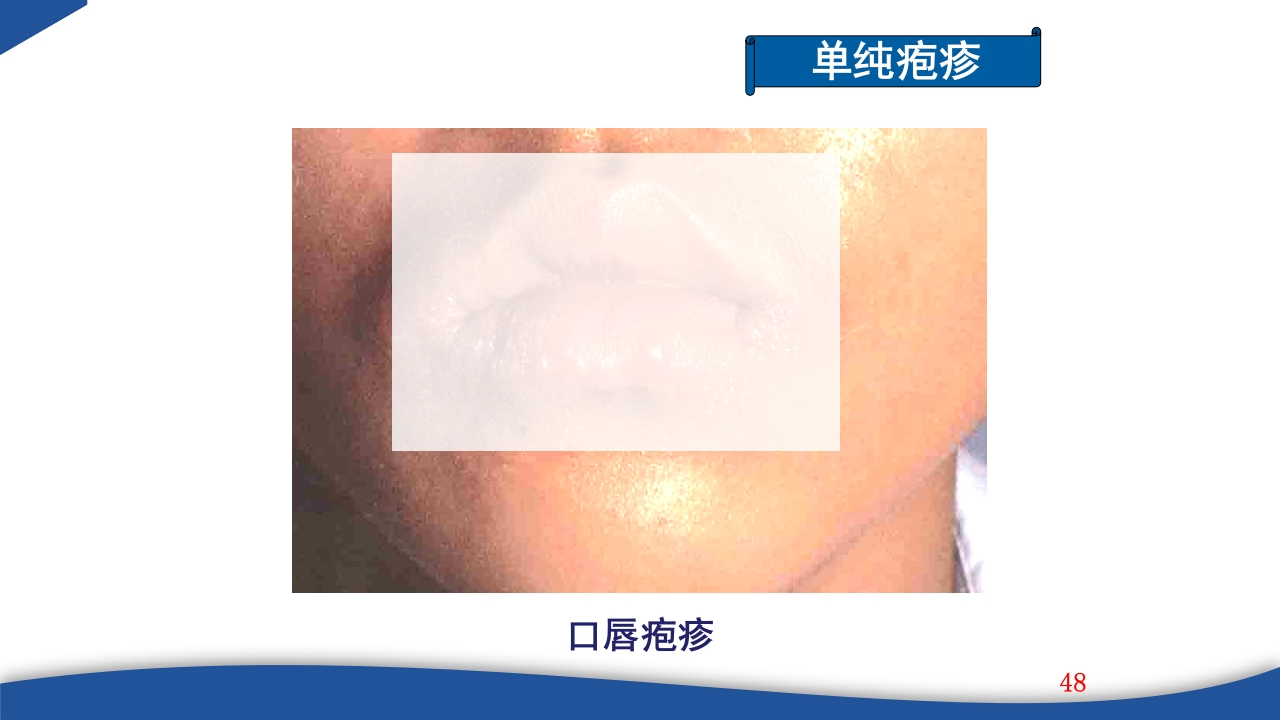 带状疱疹教学PPT课件48