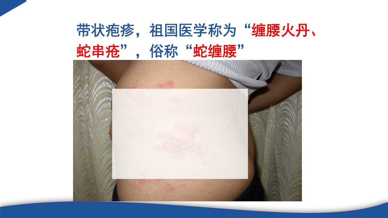 带状疱疹教学PPT课件5