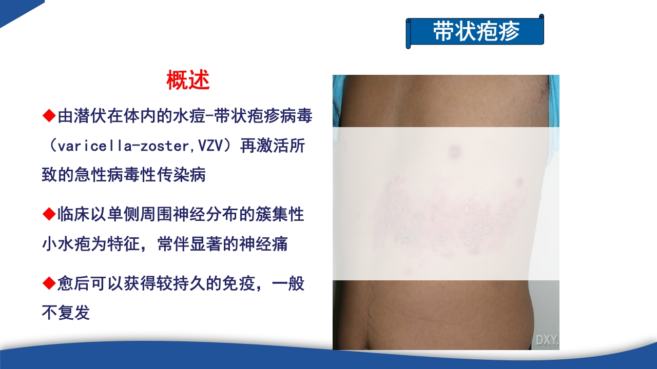 带状疱疹教学PPT课件6