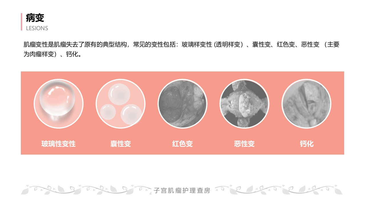 子宫肌瘤病人的护理查房PPT课件17