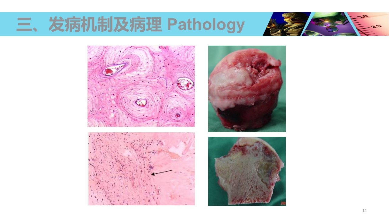 股骨头无菌性坏死PPT课件12