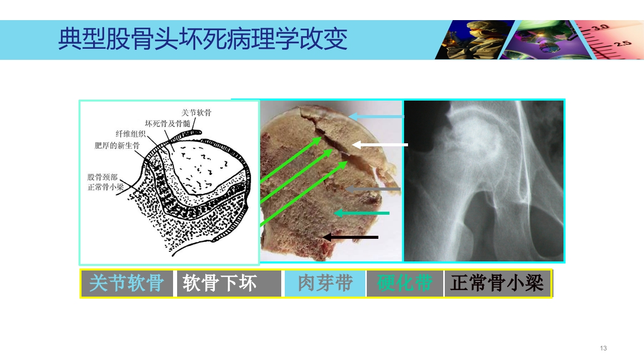股骨头无菌性坏死PPT课件13