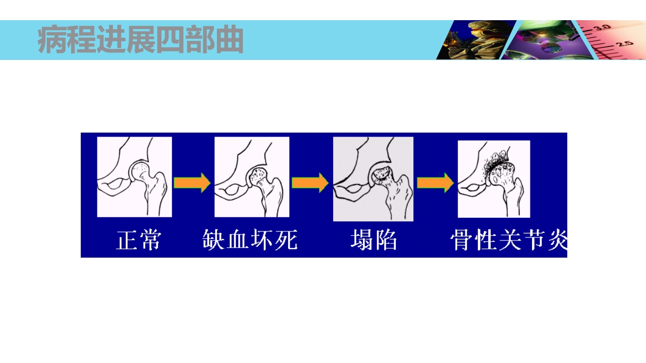 股骨头无菌性坏死PPT课件14