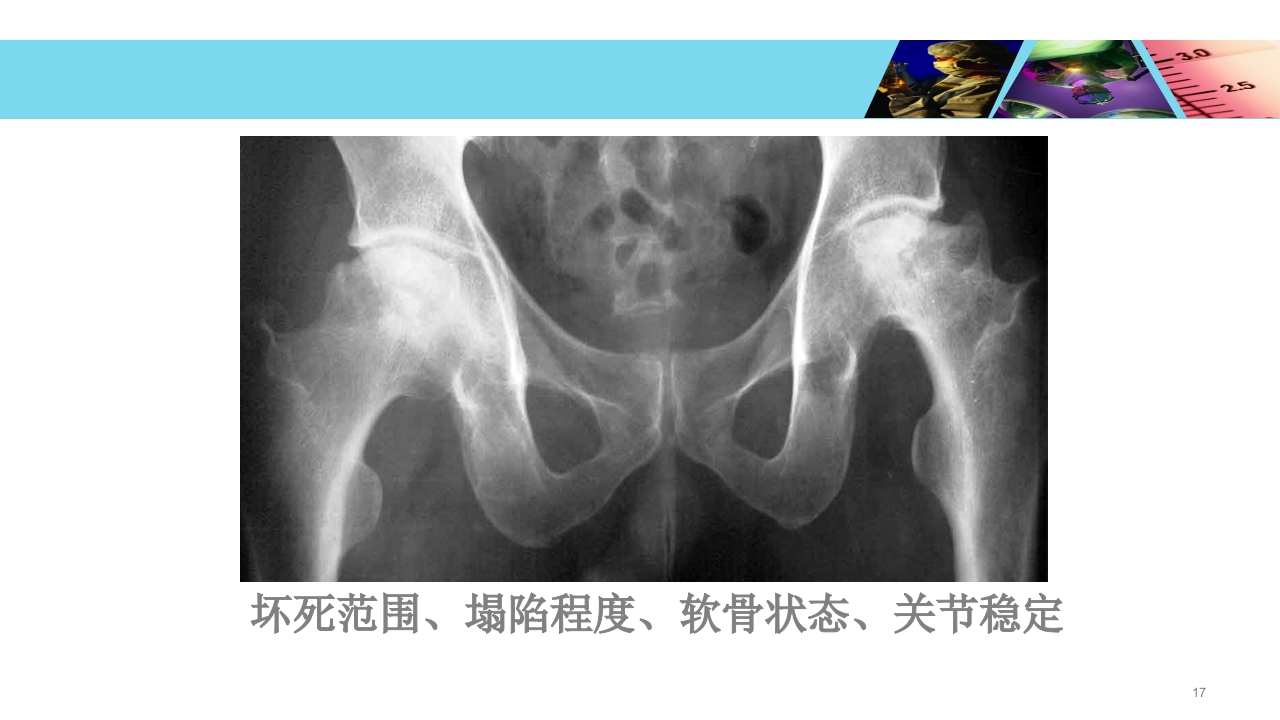 股骨头无菌性坏死PPT课件17