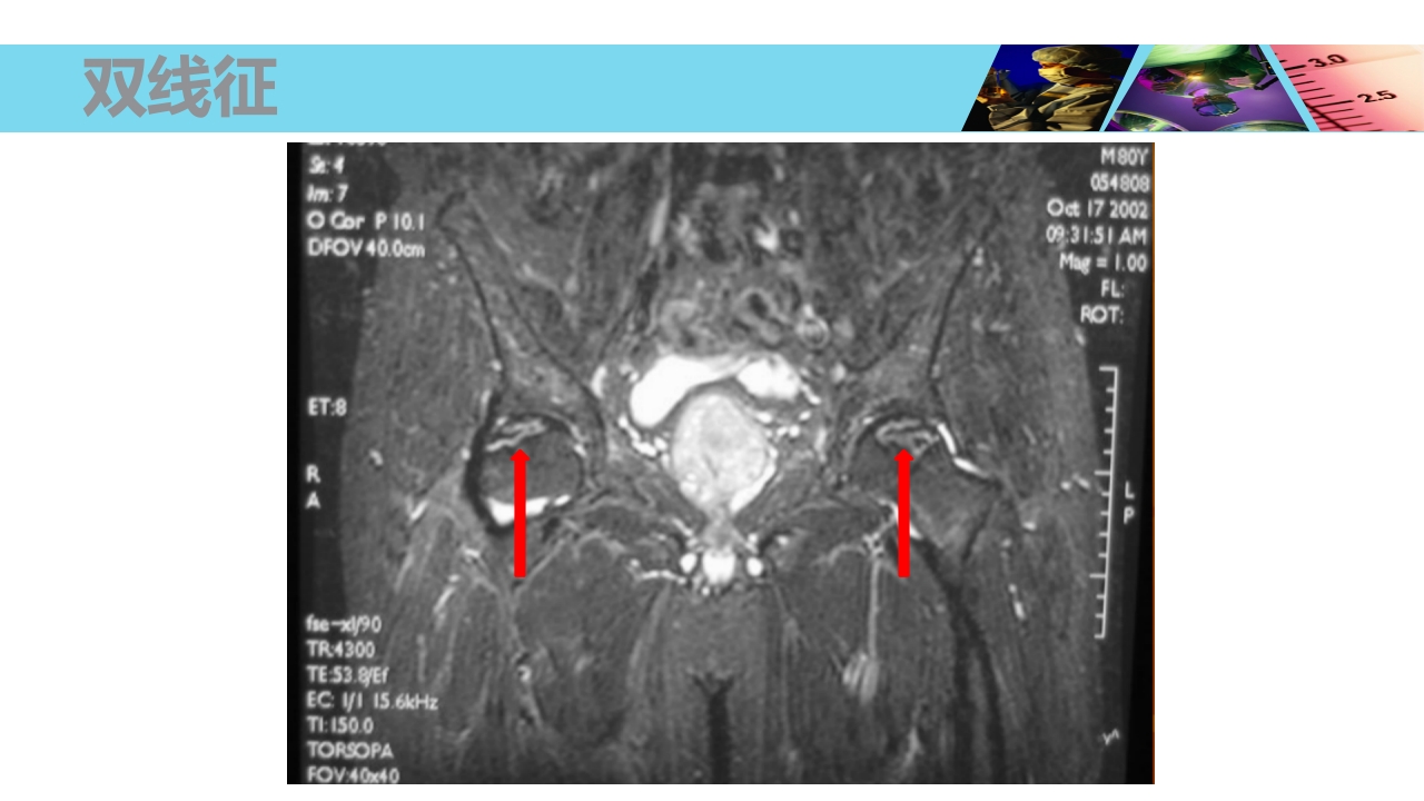 股骨头无菌性坏死PPT课件18