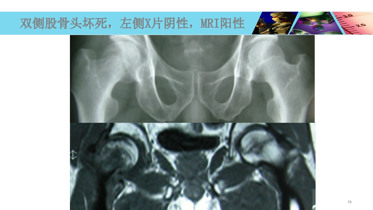 股骨头无菌性坏死PPT课件19