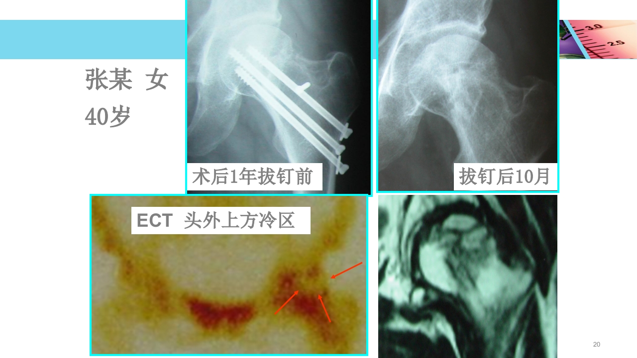股骨头无菌性坏死PPT课件20
