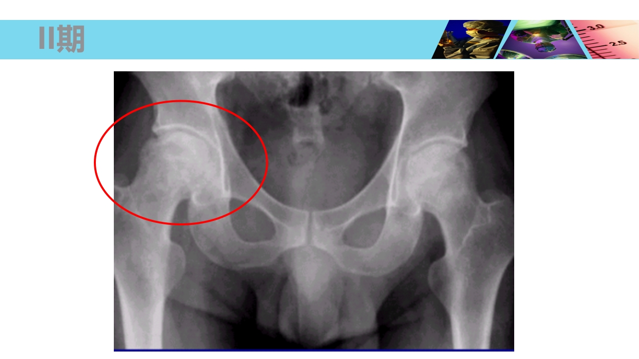 股骨头无菌性坏死PPT课件23