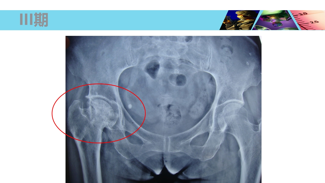股骨头无菌性坏死PPT课件24