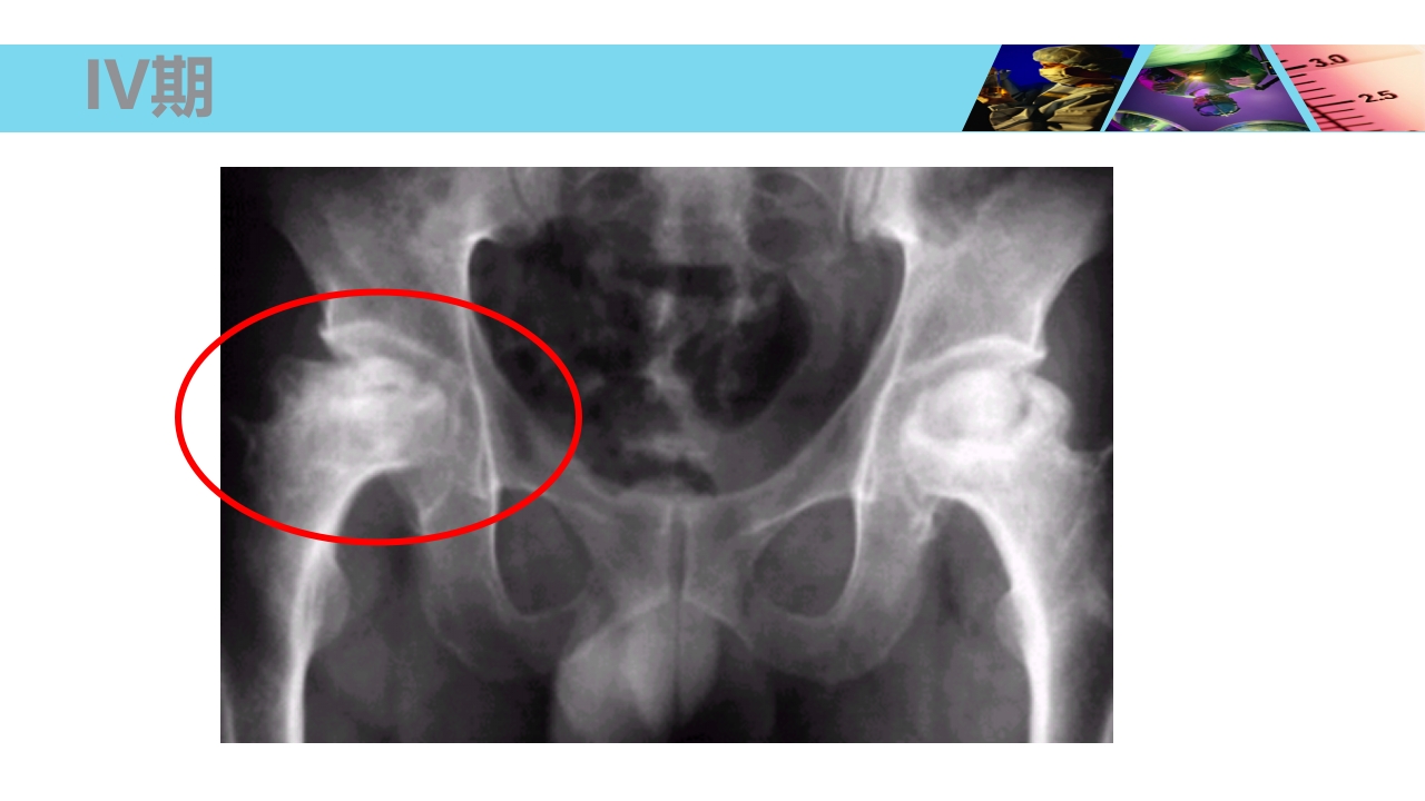 股骨头无菌性坏死PPT课件25