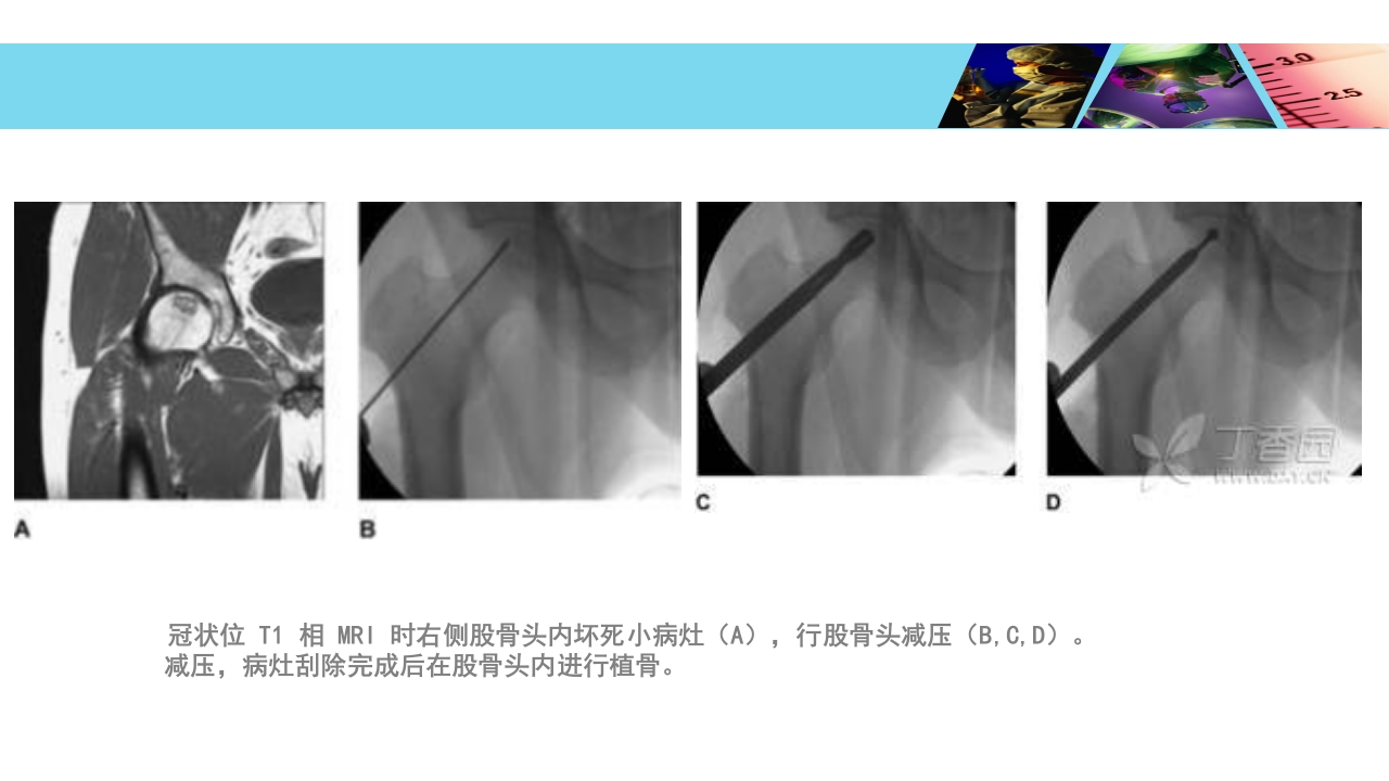 股骨头无菌性坏死PPT课件31