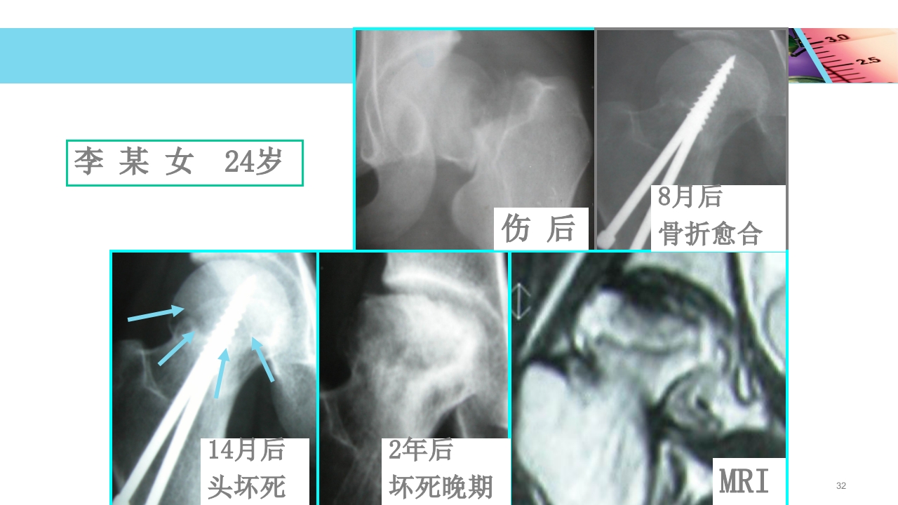 股骨头无菌性坏死PPT课件32