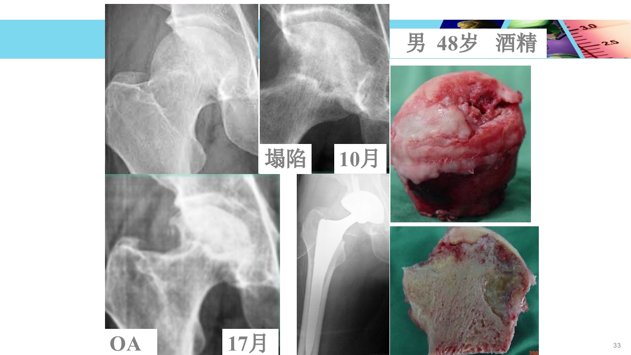 股骨头无菌性坏死PPT课件33