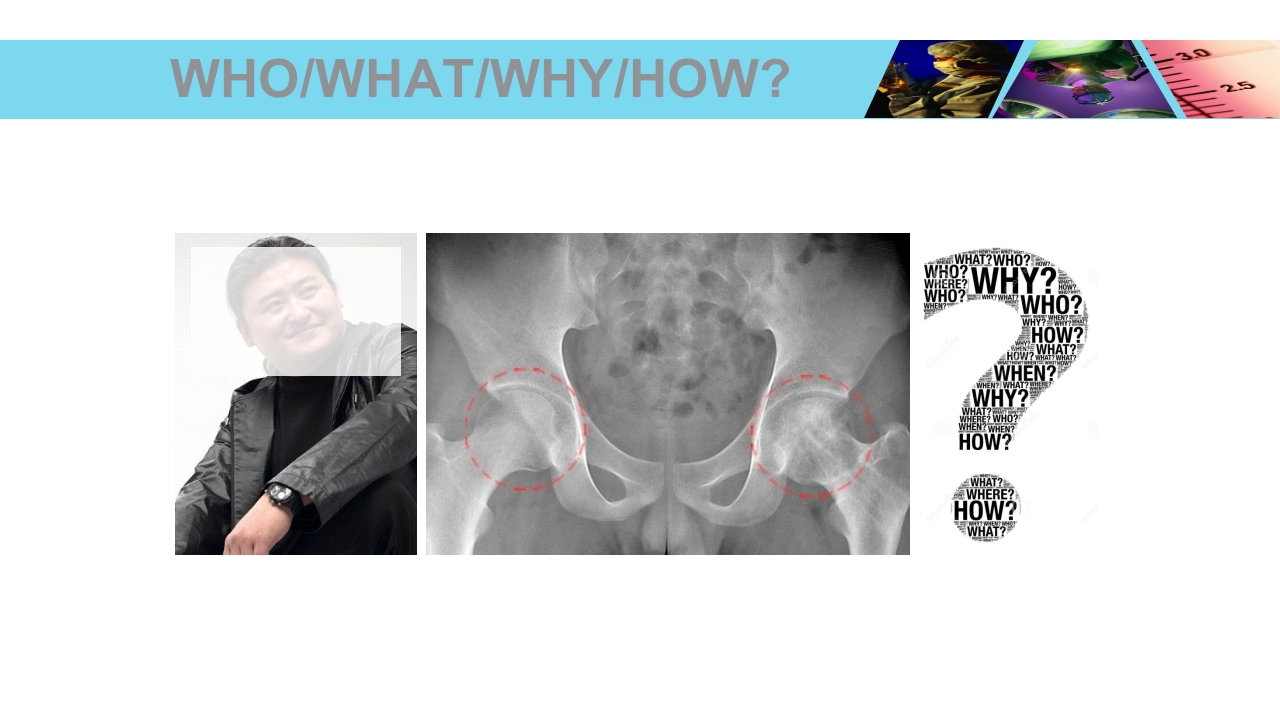 股骨头无菌性坏死PPT课件35