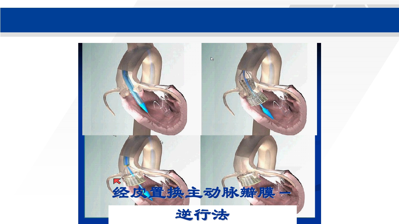 心脏瓣膜置换术后护理PPT课件18