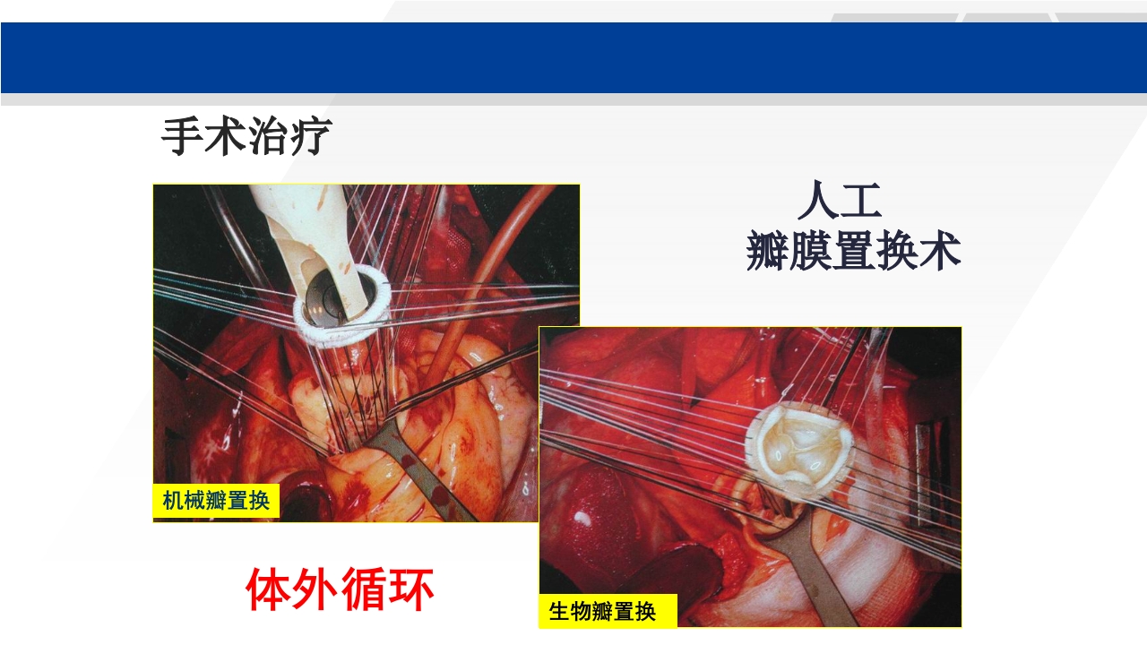 心脏瓣膜置换术后护理PPT课件19