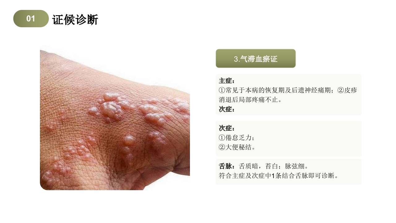 带状疱疹中医护理查房PPT课件8