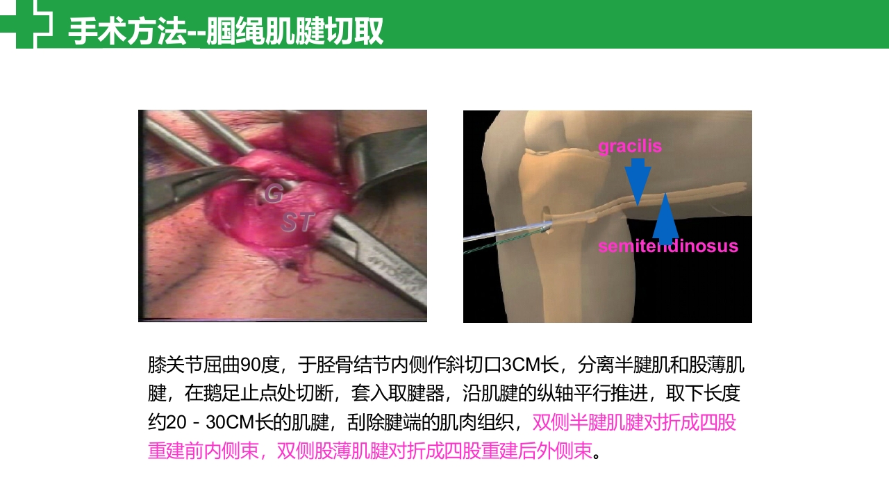 前交叉韧带损伤诊治护理查房PPT课件16