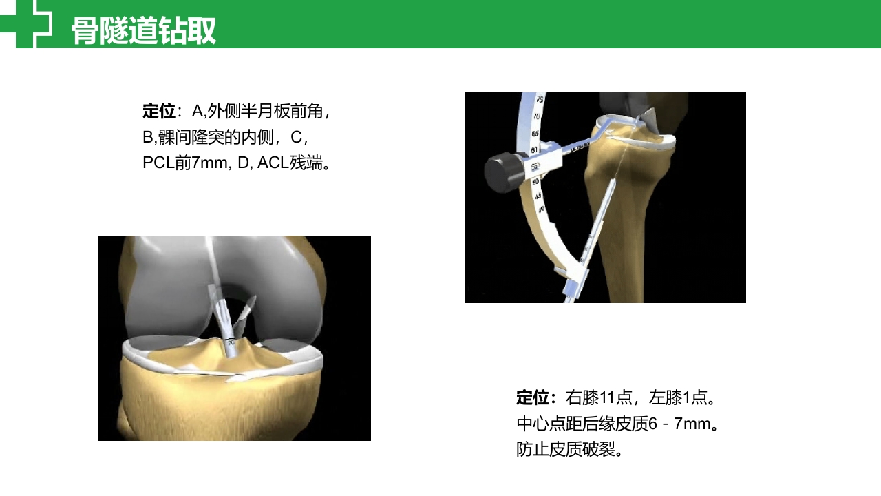 前交叉韧带损伤诊治护理查房PPT课件17