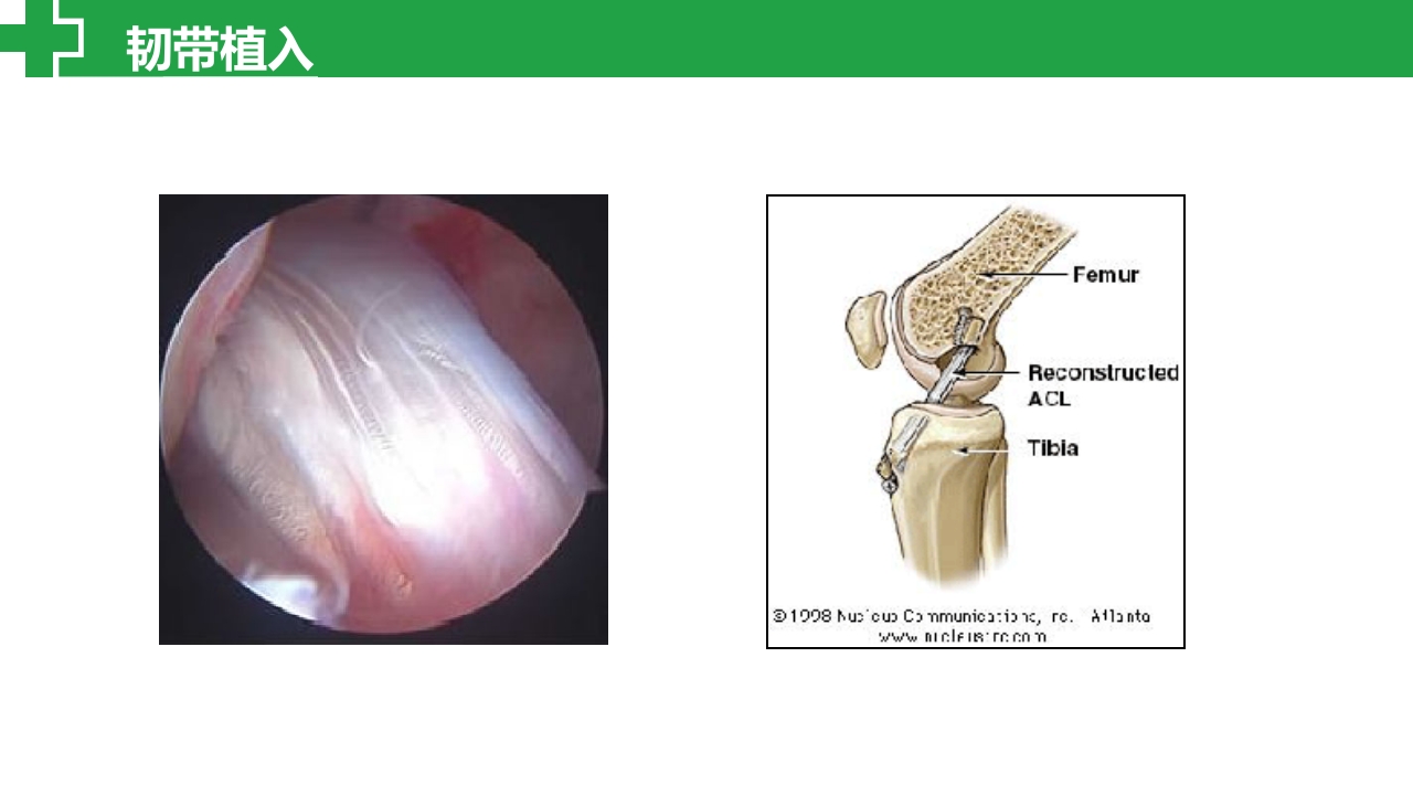 前交叉韧带损伤诊治护理查房PPT课件18