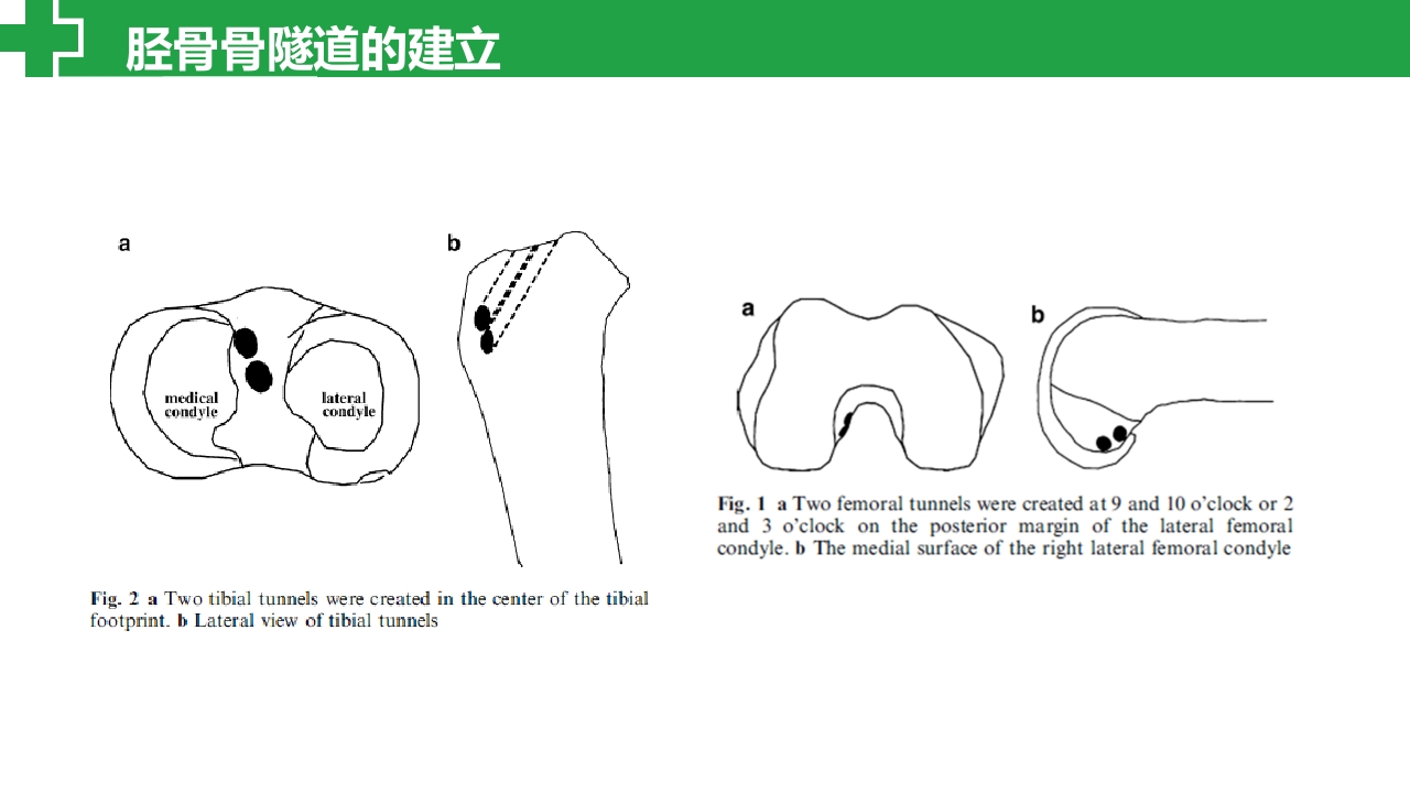 前交叉韧带损伤诊治护理查房PPT课件21