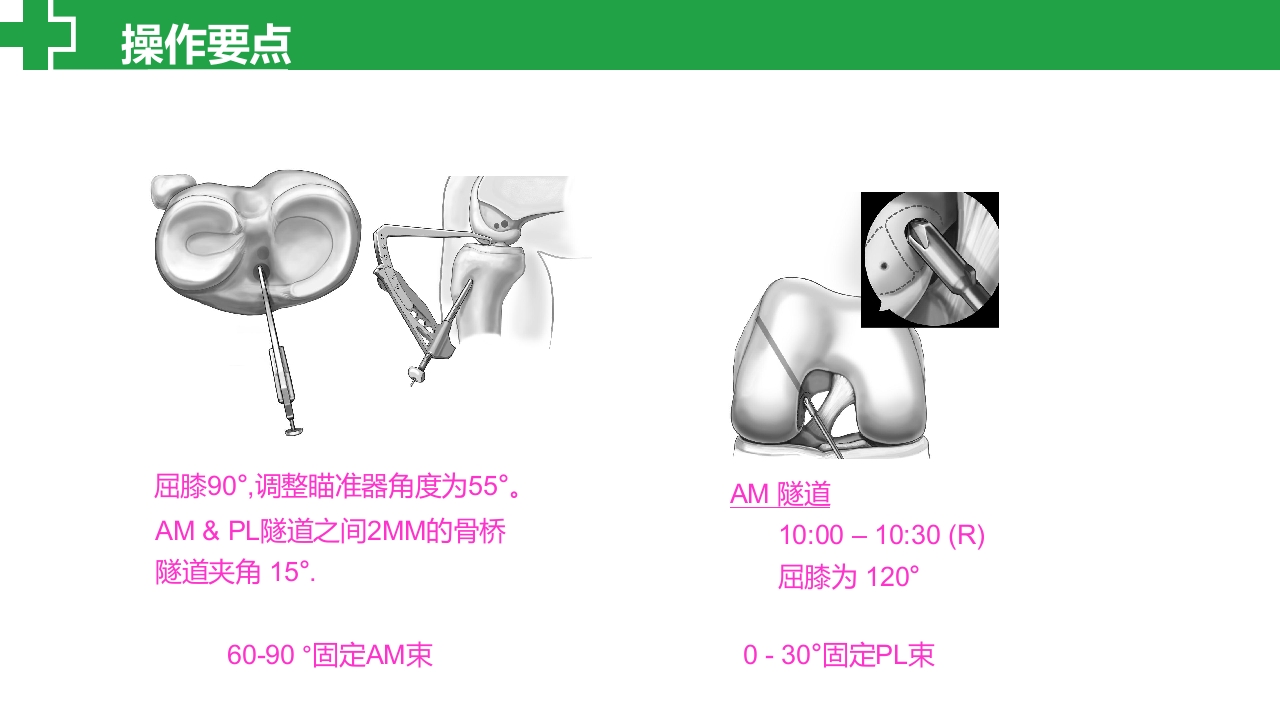 前交叉韧带损伤诊治护理查房PPT课件22