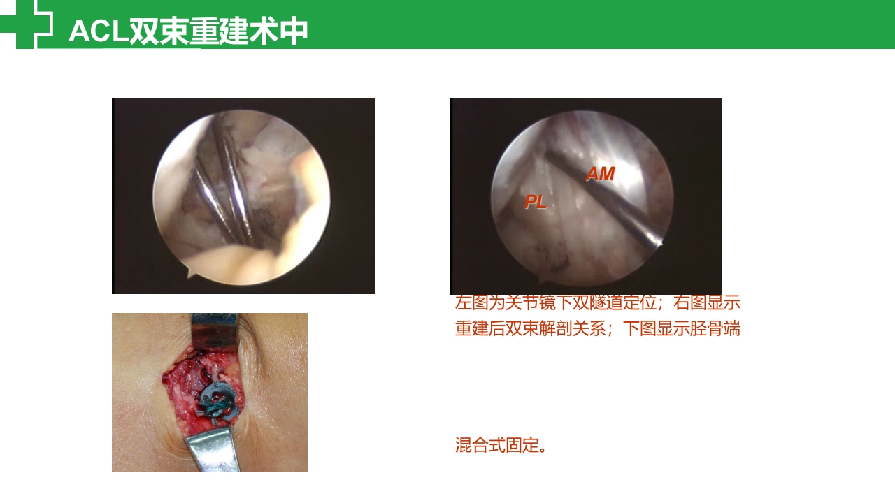 前交叉韧带损伤诊治护理查房PPT课件23