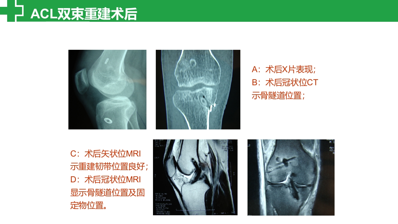 前交叉韧带损伤诊治护理查房PPT课件24