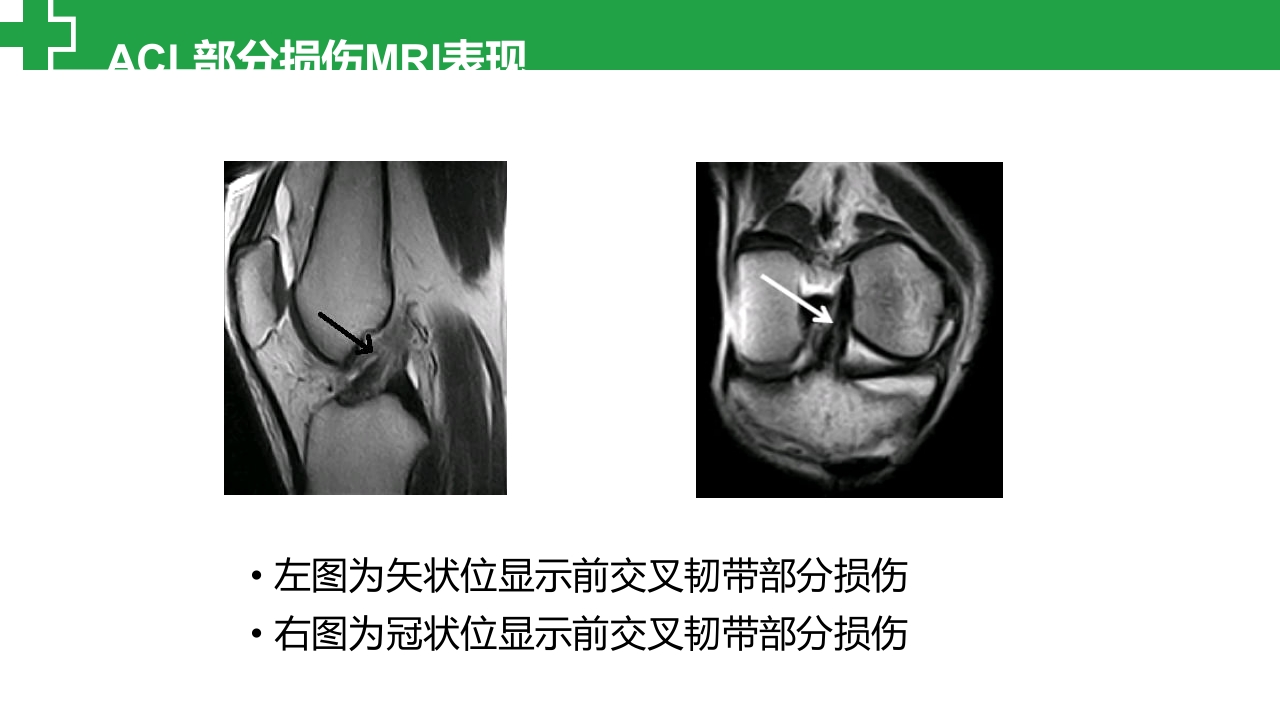 前交叉韧带损伤诊治护理查房PPT课件28