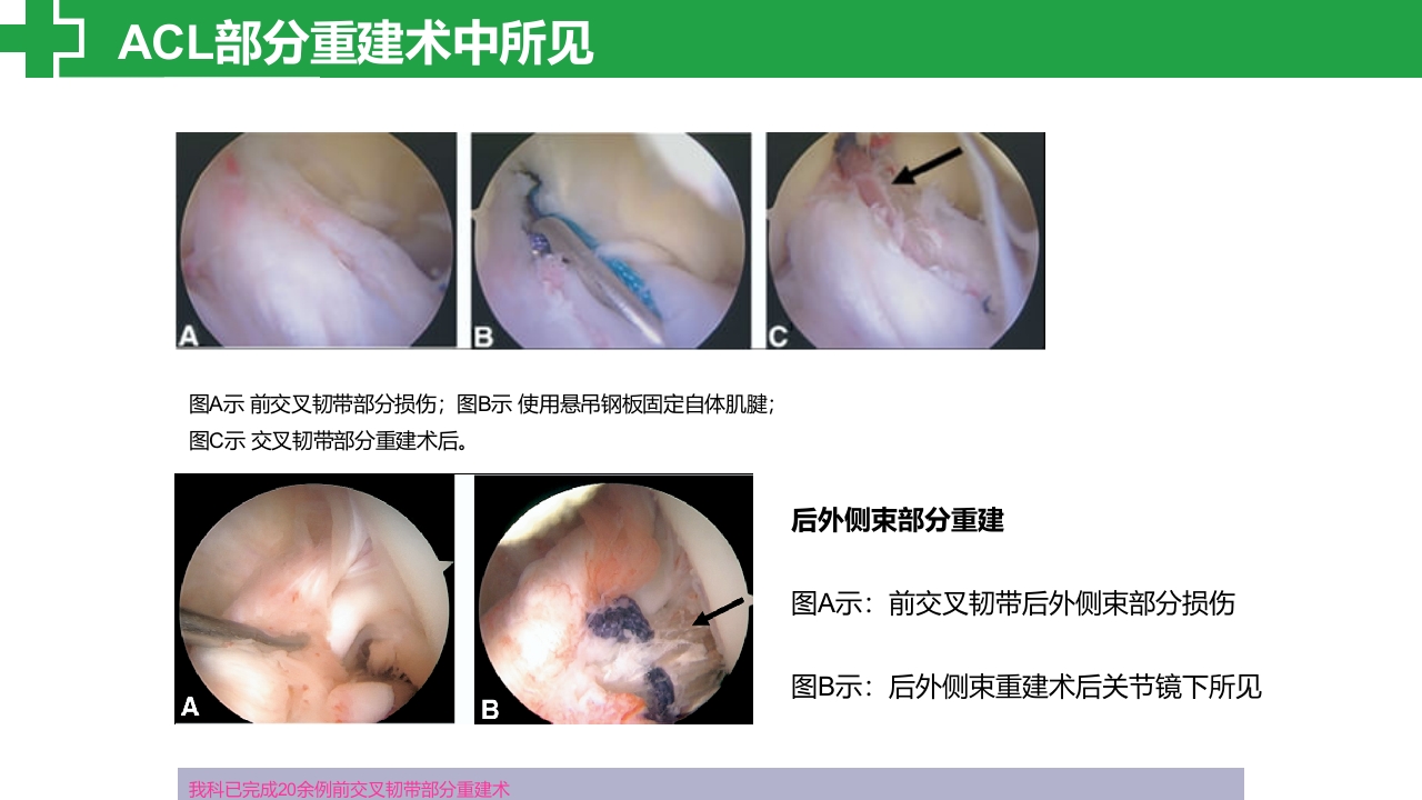 前交叉韧带损伤诊治护理查房PPT课件29