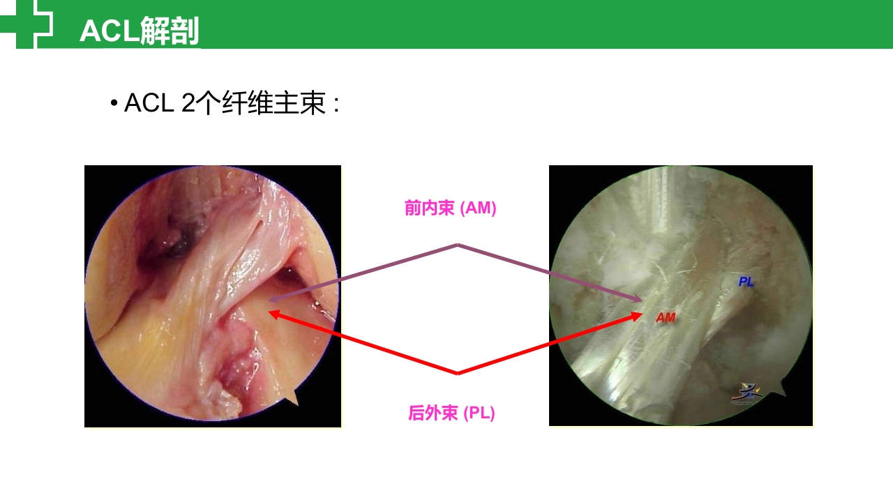 前交叉韧带损伤诊治护理查房PPT课件4