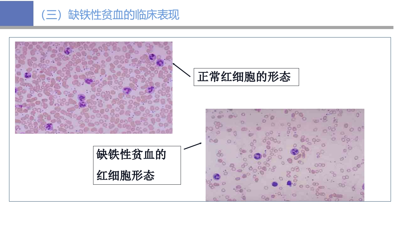 贫血病人的护理PPT课件13