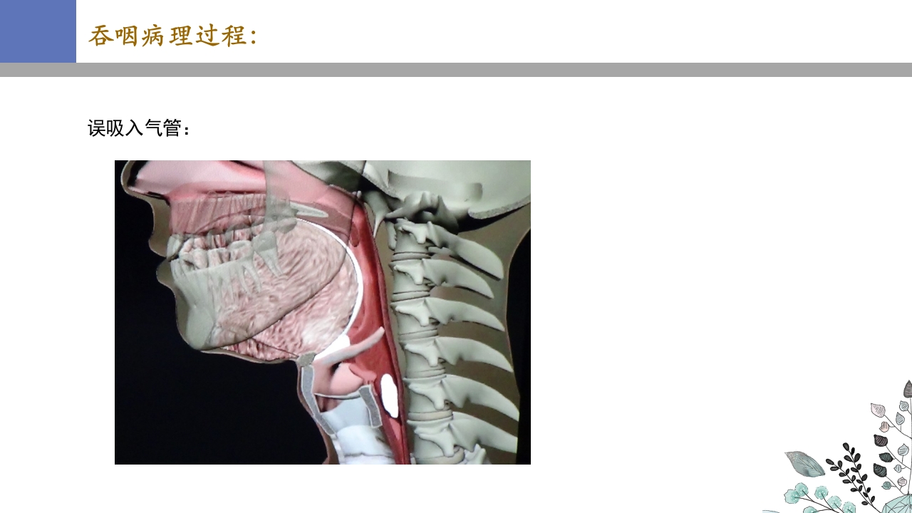 吞咽障碍PPT课件17